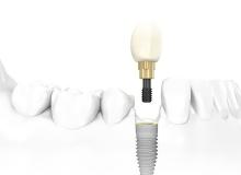 Почему важно после удаления зубов как можно быстрее их восстанавливать?