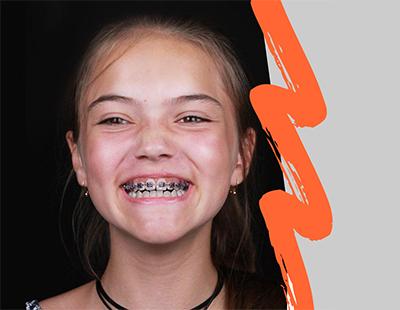 Отзыв об установке брекет-системы