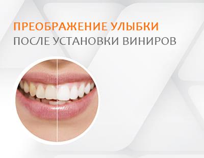 Преображение улыбки после установки виниров