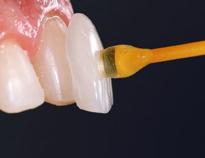 Виниры - тонкие пластинки на переднюю поверхность зубов