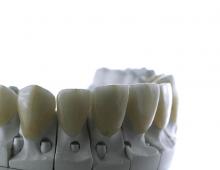 Подготовка к установке виниров