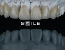 Подготовка к установке виниров