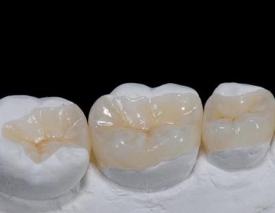 Вкладки - керамические пломбы на жевательную группу зубов