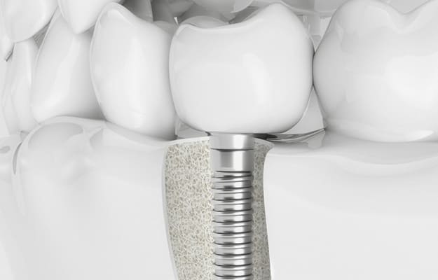 Імпланти зубів в Запоріжжі, Ціни