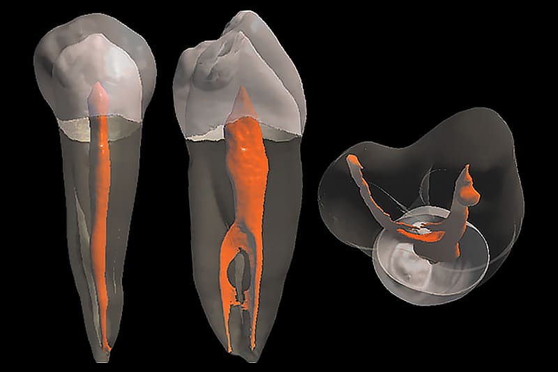 Лікування кореневих каналів