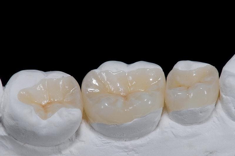 Безметалова керамічна вкладка у Запоріжжі