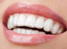 Рекомендації щодо лікування елайнерами