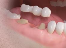 Рекомендації щодо незнімного протезування