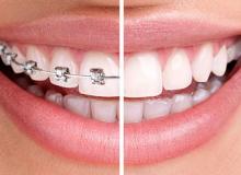 В стоматології SMILE з'явилася розстрочка на брекети