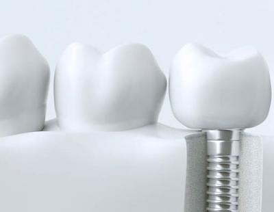 Знижка -10% на імплантацію у стоматології на Бородинській