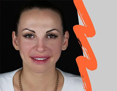 Відгук про встановлення вінірів