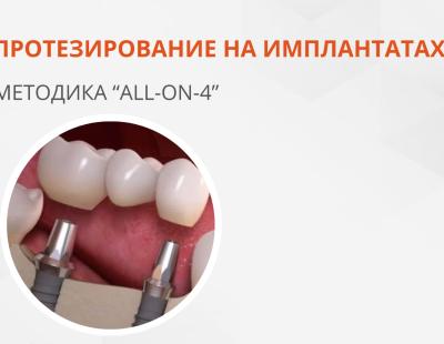Протезування на імплантах