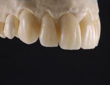 Підготовка до встановлення вінірів