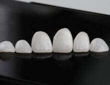 Вініри – керамічні накладки ідеальної форми